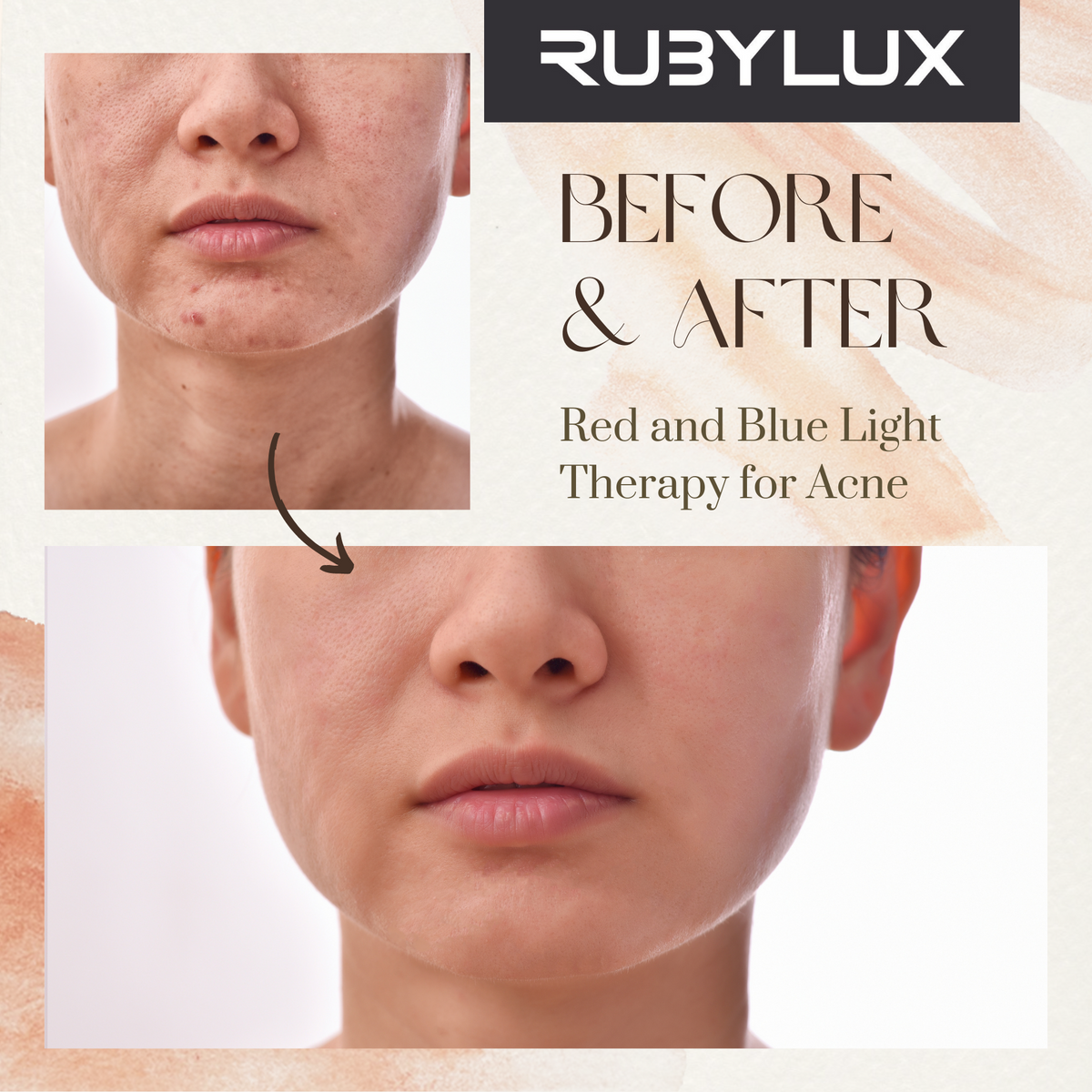 Red Light Therapy for Acne Treatment Clearing Up Your Skin Naturally RubyLuxLights