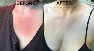 RubyLux Red Light Therapy for Sunburn Before & After 