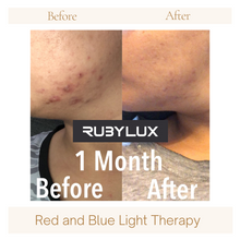Before and After Red and Blue Light Therapy for Acne.